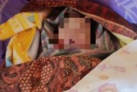 Kondisi fisik bayi yang dinilai tidak wajar, ditemukan adanya lebam kemerahan pada beberapa bagian tubuh, termasuk di pipi kiri, pipi kanan, dan leher. (Dok-Foto)