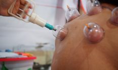 Manfaat Bekam: Terapi Sehat Yang Sudah Teruji Sejak Zaman Dahulu